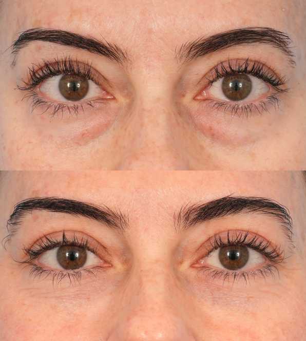 SoilBoost™ Sérum contour des yeux à l'huile de ricin – Traitement anti-cernes et anti-poches