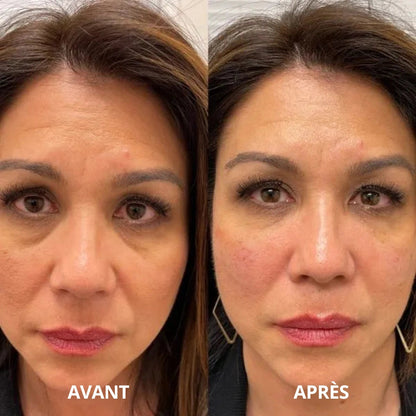 Patchs hydrogel SoilBoost au collagène et aux peptides