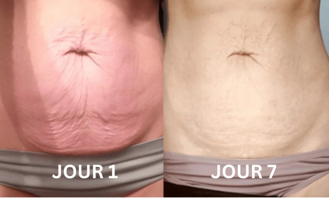 Elycura™ | Raffermit et affine la peau relâchée de 98 % en 24 heures