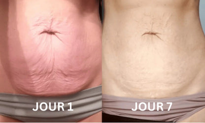 Elycura™ | Raffermit et affine la peau relâchée de 98 % en 24 heures