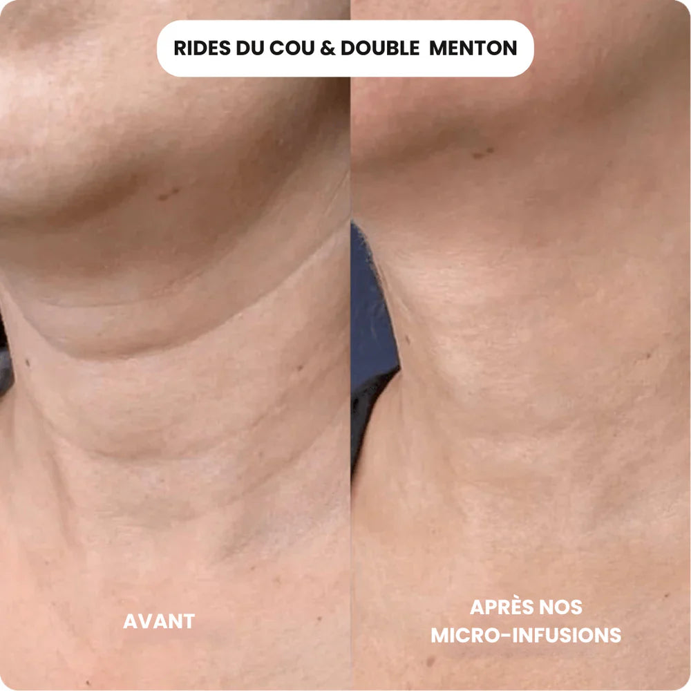 SoilBoost™ Micro-Infusion Lift Pro + Sérum extra offert