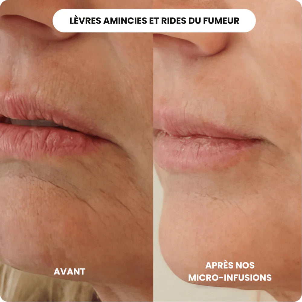 SoilBoost™ Micro-Infusion Lift Pro + Sérum extra offert